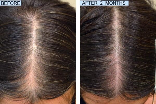 What is the most effective hair growth system?, Which hair supplement is best for hair growth?, What is the fastest hair growth supplement?, What is the safest hair regrowth product?, fully vital hair growth reviews, enhance hair, enhance hair and beauty, enhance hair restoration, enhance hair growth, enhance hair transplant, enhance hair studio, enhance hairdressers, enhance hair care, enhance hair salon, enhance hair restoration reviews, fully vital enhance hair, fully vital enhance hair reviews, fully vital hair, vital hair growth, hair transplant finance, free hair transplant, hair transplant clinic, fue hair transplant, fully vital hair growth system, fully vital hair growth system amazon, fully vital hair growth system amazon interview, fully vital hair growth system at home, fully vital hair growth system before and after, fully vital hair growth system buy, fully vital hair growth system before and after pictures, fully vital hair growth system black hair, fully vital hair growth system cost, fully vital hair growth system curly hair, fully vital hair growth system cream, fully vital hair growth system for black hair, fully vital hair growth system for natural hair, fully vital hair growth system how to use, fully vital hair growth system instructions, fully vital hair growth system india, i restore hair growth system reviews, fully vital hair growth system kit, fully vital hair growth system keto, fully vital hair growth system low porosity hair, fully vital hair growth system naturally, enhance hair, enhance hairline, enhance hair photoshop, enhance hair growth, enhance hair colour, enhance hair grow lotion, enhance hair grow lotion 5 solution, enhance hair color without dye, enhance hair products, enhance haircut, enhance hair growth lotion, enhance hair color, enhance hair growth naturally, enhance hair solihull, enhance hair and nails, enhance hair at home, enhance hair and makeup, enhance hair aliexpress, promoting hair business, increase beard hair density, increase body hair, increase body hair growth, increase baby hair growth, enhance curls black hair, best products to enhance wavy hair, best hair products to enhance curls, enhance hair care, enhance curly hair naturally,